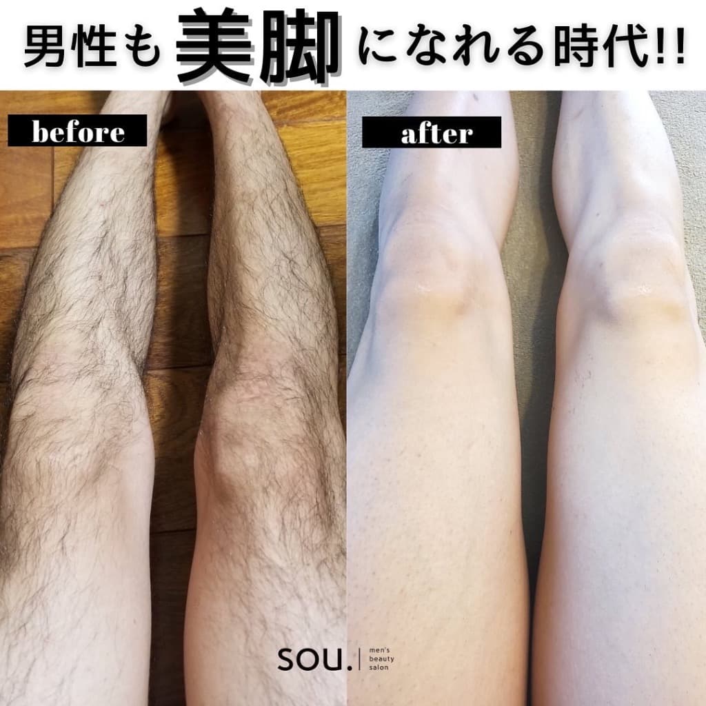 脚の脱毛 施術例（ビフォーアフター）